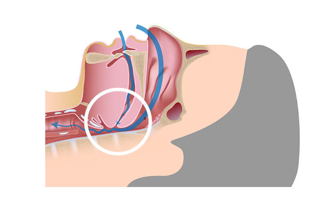 Sleep apnea diagram hypopnea snoring