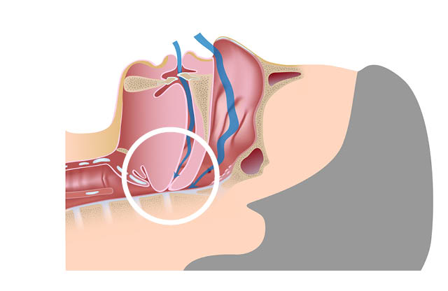 Sleep apnoea diagram severe restricted airway