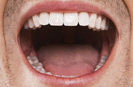 sleep apnoea dental devices